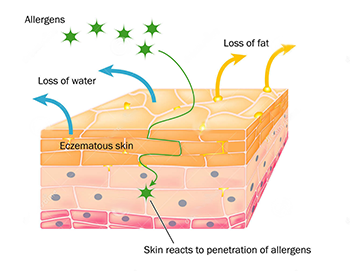 Causes Eczema